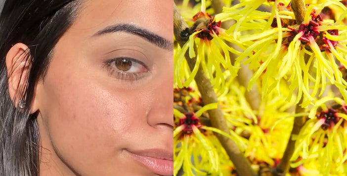 Top Witch Hazel Skin Benefits & How to Use It