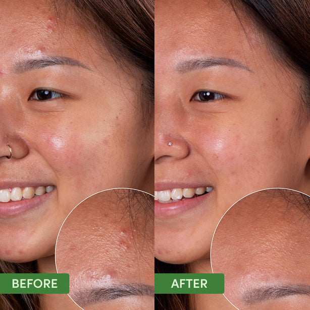 Oil Control Clearing Cleanser gel texture - deep cleansing formula for oily acne-prone skin